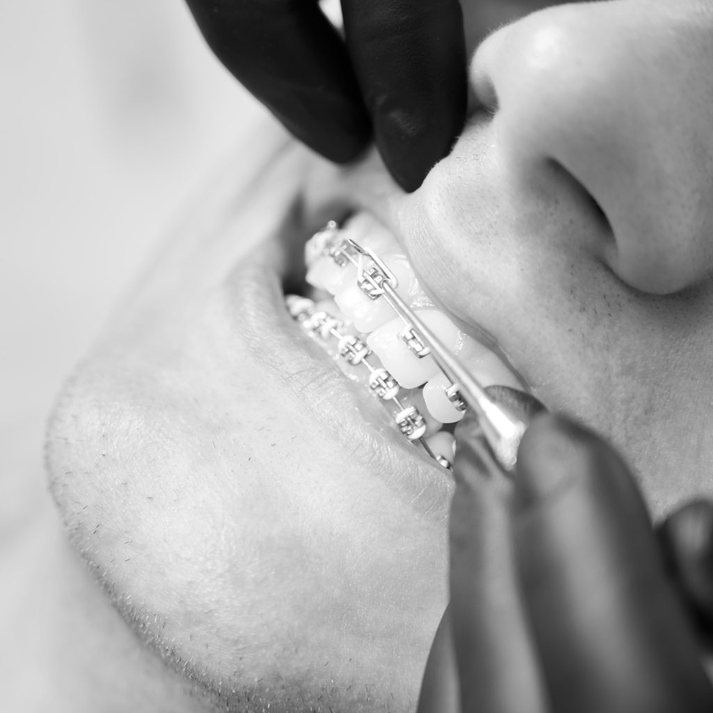 cuanto vale un implante dental
