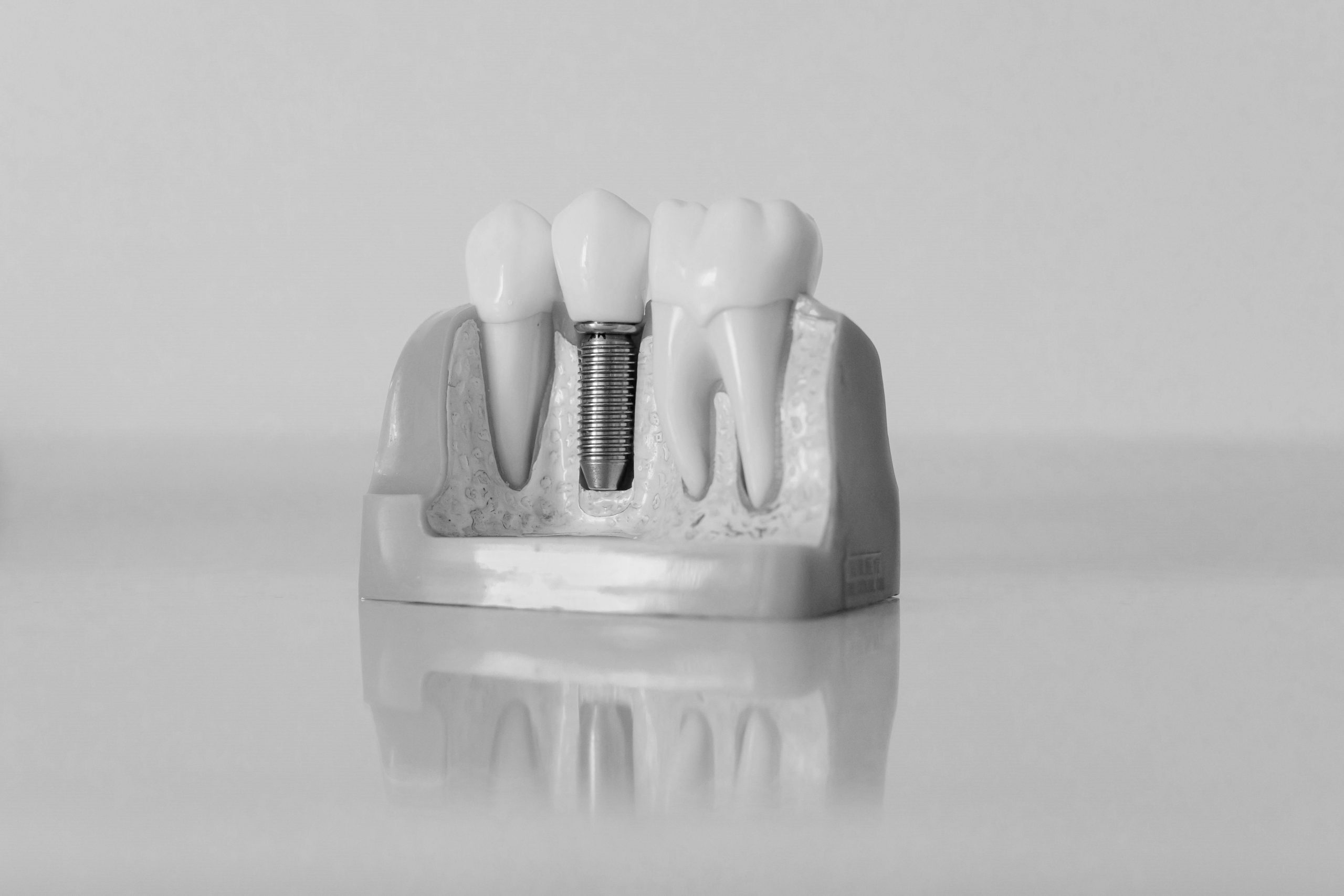 implantes sobre protesis